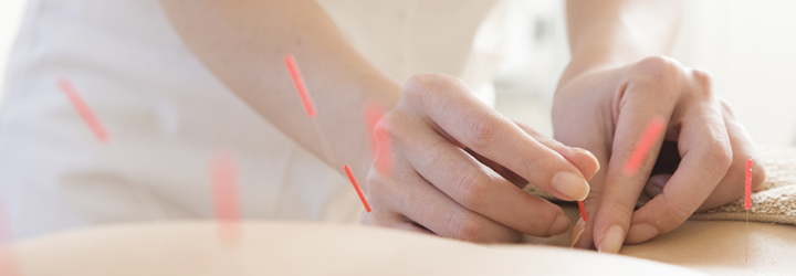 鍼灸施術の様子